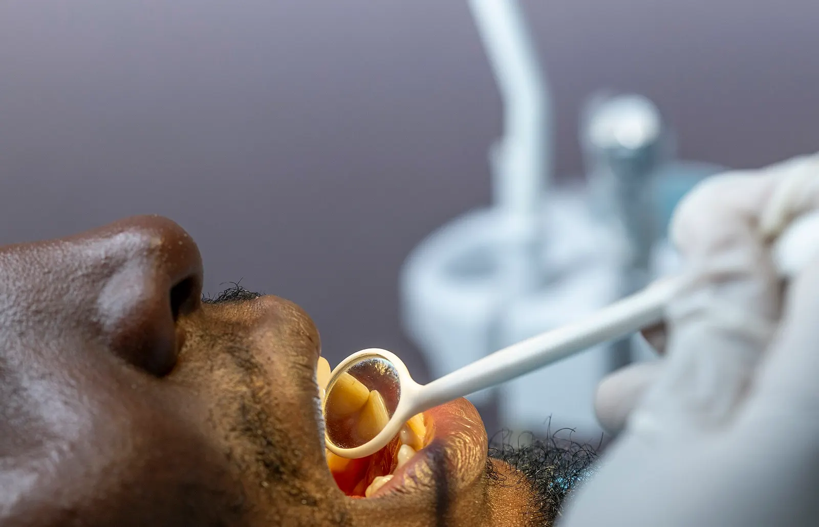 A dentist’s gloved hand holds a dental mirror inside a patient’s open mouth during an exam